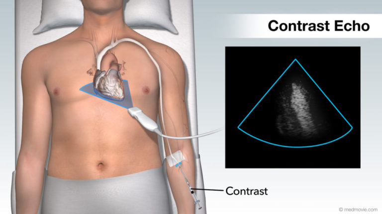 types-of-heart-ultrasound-see-my-heart-american-society-of